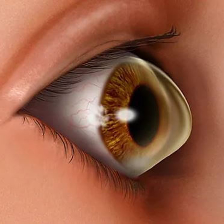 Armoring the Cone Innovation in the Treatment of Keratoconus Optical