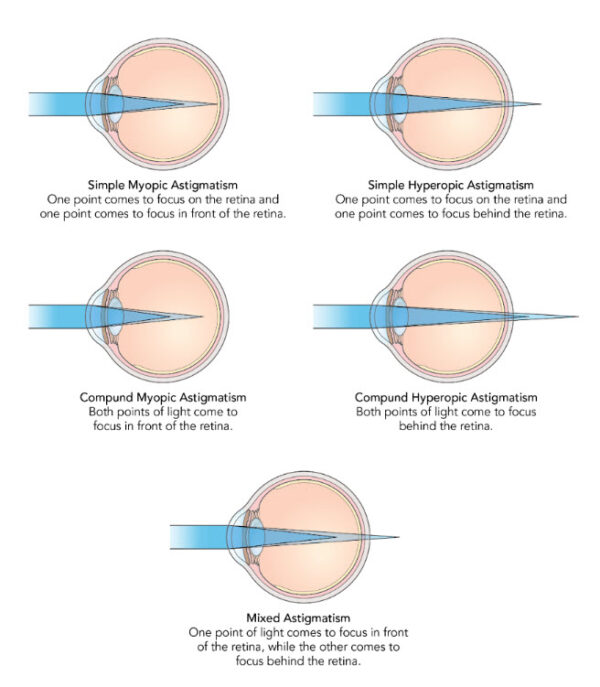 Top Contact Lenses for Astigmatism: A Comprehensive Review